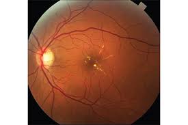 Diabetic Macular Edema Market