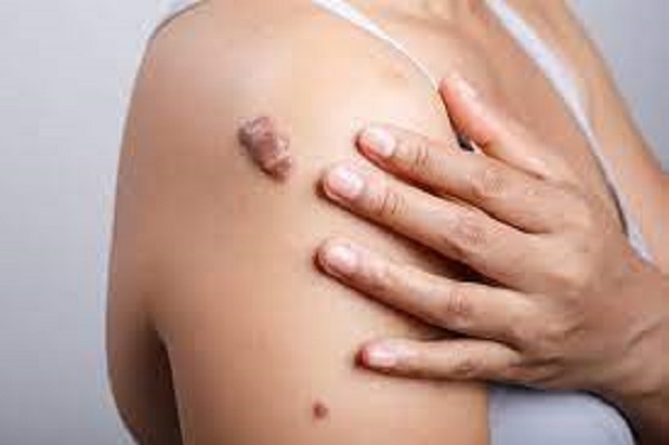 Keloid Market