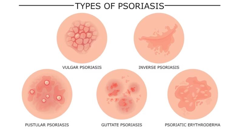 Plaque Psoriasis Market
