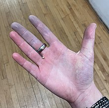 Raynaud's Disease Market