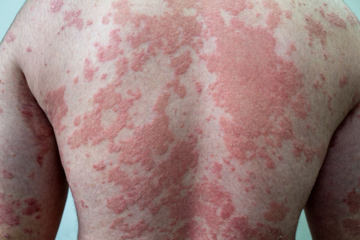 psoriasis market 11