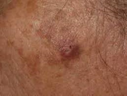 Cutaneous Squamous Cell Carcinoma Market
