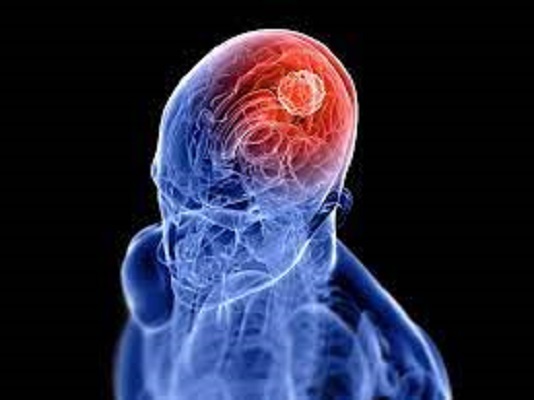 Glioma Market 11
