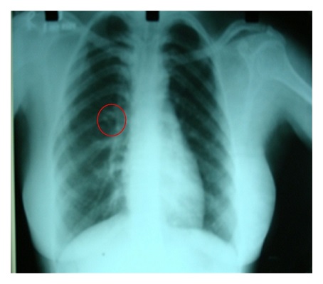 Gorlin Syndrome Market