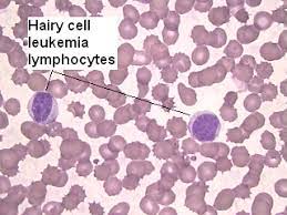 Hairy Cell Leukemia Market