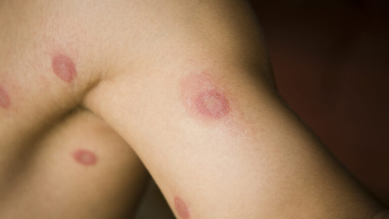 Human ringworm