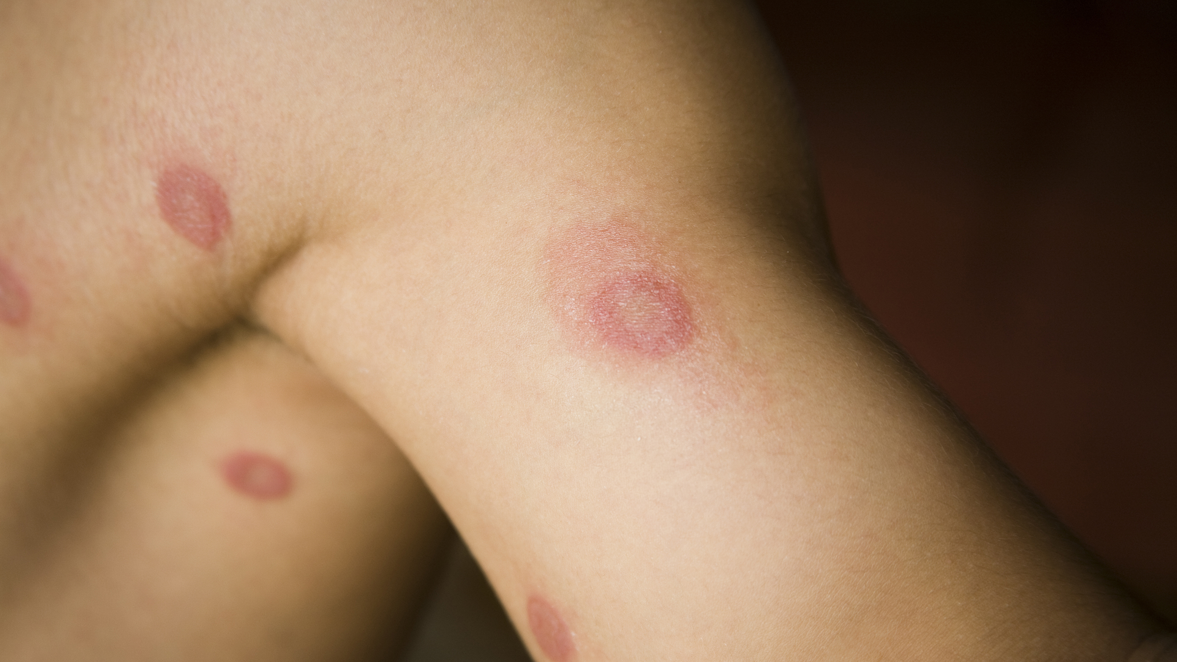 Human ringworm