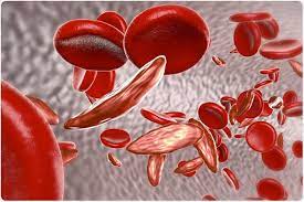 Sickle Cell Disease Market