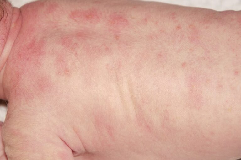 kawasaki disease market