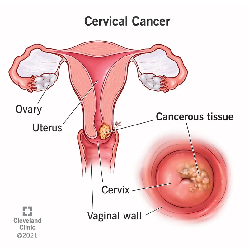Cervical Cancer Diagnostics Market