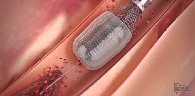 Japan Thrombectomy Devices Market