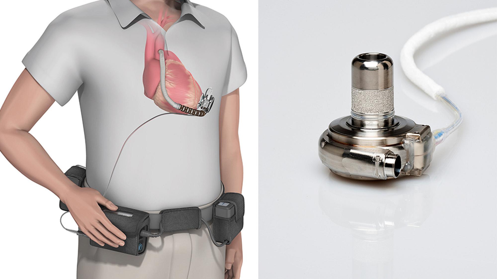 Japan Ventricular Assist Devices Market