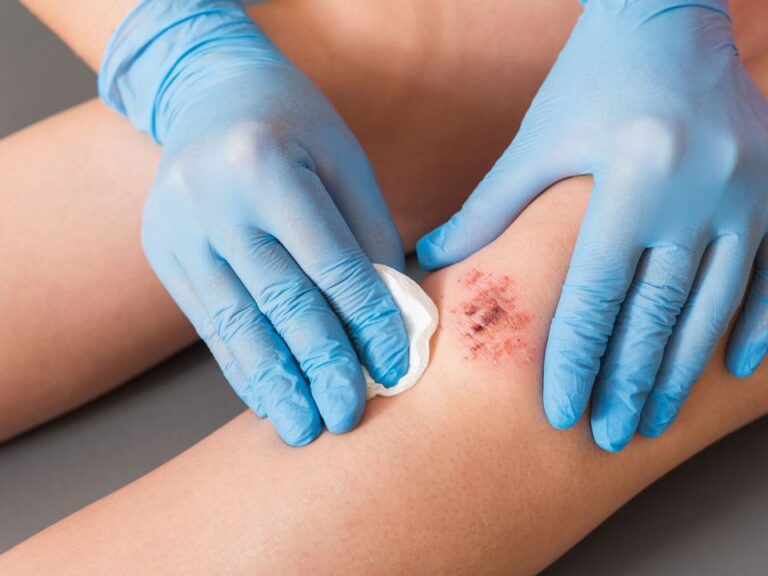 Japan Wound Care Market
