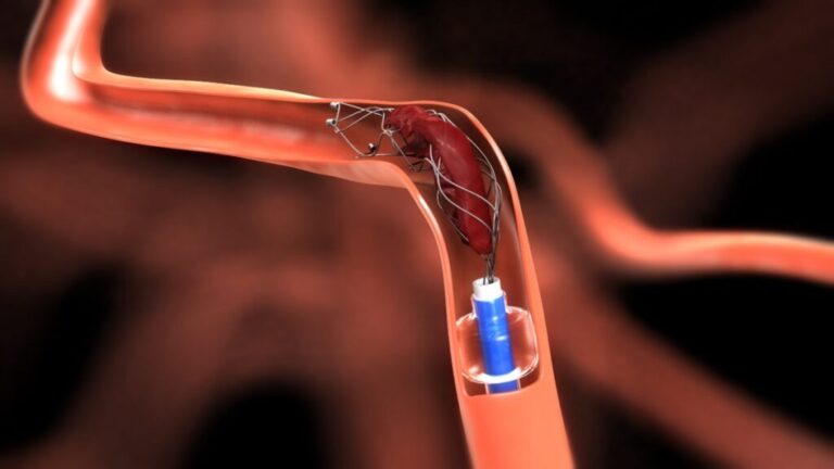 Japan Neurovascular Devices Market